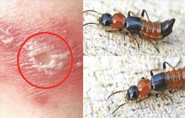 Bị kiến ba khoang cắn – Dấu hiệu bị kiến ba khoang cắn